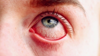 đau mắt đỏ