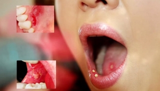 5 cảnh báo vấn đề sức khỏe ở vùng răng miệng nhất định không được bỏ qua