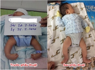 Nghệ An: Điều trị thành công bàn chân khoèo cho trẻ sơ sinh bằng phương pháp Ponseti - Ảnh 1.