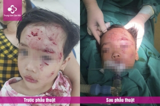 Phú Thọ: Bé gái 3 tuổi bị chó nhà hàng xóm cắn lộ xương trán - Ảnh 1.