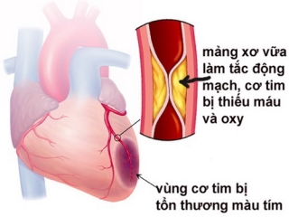 Xơ vữa động mạch là yếu tố nguy cơ của bệnh tim mạch.
