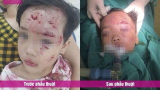 Bé gái 3 tuổi bị chó cắn tổn thương nặng vùng mặt