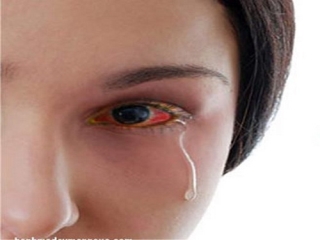 Đỏ mắt, chảy nước mắt là những dấu hiệu bị dị ứng mắt.