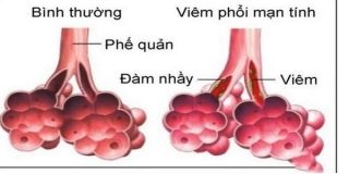 Không được chủ quan với viêm phổi ở người lớn.