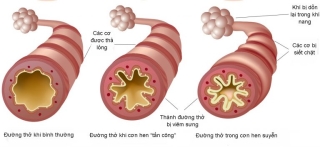 Cách sống chung với hen phế quản