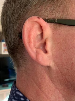 Người đàn ông phải cắt một phần tai khi phát hiện chấm đổi màu trên da