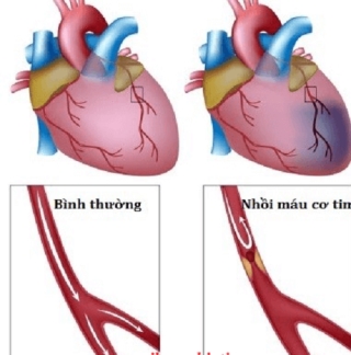 Nhồi máu cơ tim cấp