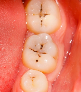Những bệnh lý răng miệng có thể gây mất răng vĩnh viễn - Ảnh 3.