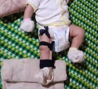 Cháu bé 2 tháng tuổi nghi bị cha ruột đánh gãy chân - Ảnh 1.
