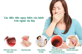 Trào ngược dạ dày - thực quản không xử lý kịp thời có thể cực kỳ nguy hiểm: Bác sĩ BV K chỉ ra 1 điều rất quan trọng nếu muốn điều trị thành công - Ảnh 2.