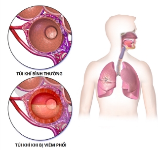 Túi khí bình thường và túi khi khi bị viêm phổi.
