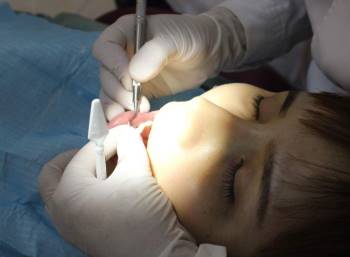 Thường xuyên bị chảy máu khi đánh răng, cô gái 26 tuổi bị viêm nha chu nặng, phải vĩnh biệt cùng lúc 11 chiếc răng - Ảnh 1.