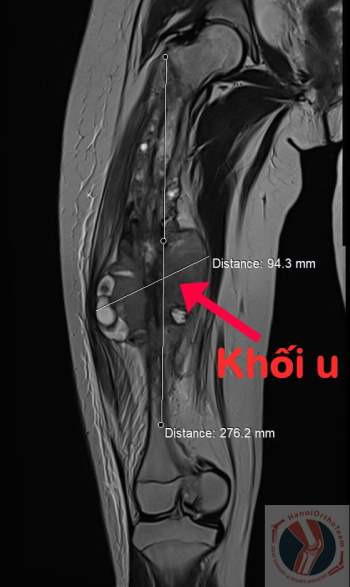 Kỳ tích bệnh nhi nhỏ tuổi nhất Việt Nam được thay toàn bộ xương đùi -0