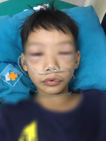 Bé trai 10 tuổi sốc phản vệ phù nề vùng môi và mí mắt hai bên sau uống Thuốc tự mua chữa ho, sốt - Ảnh 1.