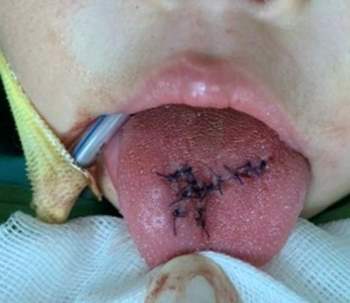 Bé 1 tuổi bị T*i n*n rách lưỡi, nguyên nhân trẻ nào cũng dễ gặp phải - Ảnh 3.