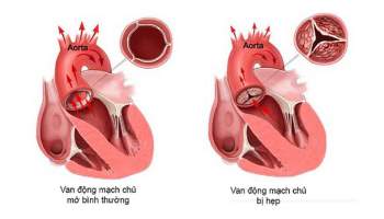 Hẹp van động mạch chủ là bệnh phổ biến nhất về van tim.