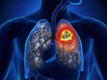 kết hợp hóa trị và liệu pháp miễn dịch cho hiệu quả cao hơn trong điều trị ung thư phổi tế bào nhỏ không vảy