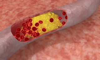 Cholesterol máu cao ảnh hưởng xấu đến đời sống T*nh d*c.