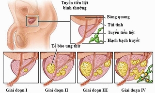 Ung thư TTL nếu được phát hiện và điều trị đúng cách có thể chữa khỏi.