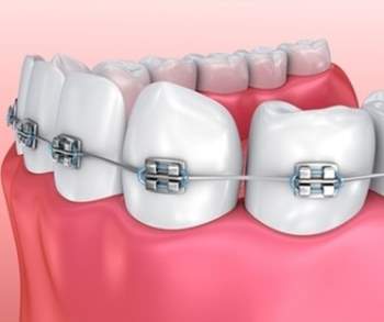 Bác sĩ chỉnh nha nêu ra những sai lầm khiến bạn niềng răng không thành công - Ảnh 6.