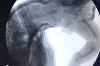 Quảng Nam: Bé sơ sinh bị gãy xương đùi khi sinh mổ - ảnh 1