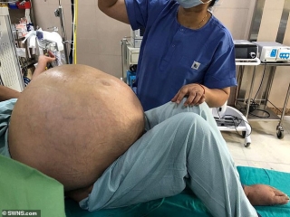 Người phụ nữ với chiếc bụng to bất thường khiến cô không thể đi lại được, đến bệnh viện kiểm tra mới biết là khối u nặng 50kg - Ảnh 1.
