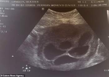 Muốn sinh thêm con nên làm thụ tinh nhân tạo, ai ngờ bác sĩ thông báo một tin bất ngờ khi siêu âm ở tuần thứ 6 - Ảnh 1.
