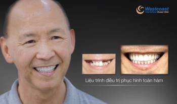 Khắc phục hậu quả trồng răng implant thất bại - ảnh 3