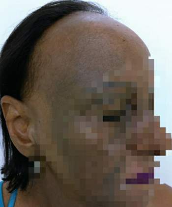 Người phụ nữ ở TP.HCM mắc bệnh lạ, đột nhiên rụng tóc, hói nửa đầu - Ảnh 1.