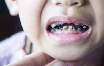 7 nguyên nhân gây sâu răng hàng đầu ở trẻ em và 3 điều cần lưu ý để chữa trị - Ảnh 1.