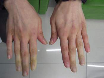 Bệnh hiếm gặp khiến ngón tay tạm thời chuyển sang màu trắng hoặc xanh lam, được ví như 