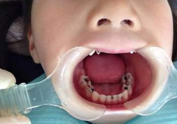 7 nguyên nhân gây sâu răng hàng đầu ở trẻ em và 3 điều cần lưu ý để chữa trị - Ảnh 2.