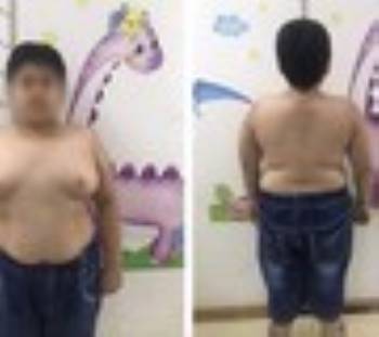 Bé trai 13 tuổi tăng cân mất kiểm soát sau khi lạm dụng Thu*c corticoid Ảnh: T.Hà