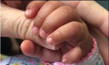 Bé gái sinh ra với 12 ngón tay do mắc phải căn bệnh này - Ảnh 5.