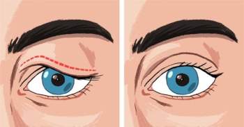 7 tuyệt chiêu giúp bạn loại bỏ bọng mắt và quầng thâm hiệu quả