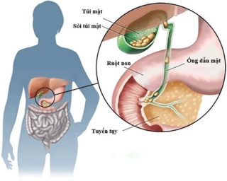 Sỏi làm tắc mật và gây viêm đường mật dẫn đến làm mủ và tạo ổ áp-xe.