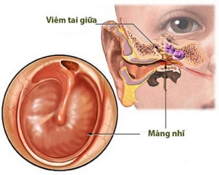 VTG ở trẻ em nếu không phát hiện và điều trị kịp thời có thể gây ra những biến chứng cực kỳ nguy hiểm.