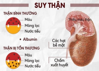 Cần cảnh giác với các dấu hiệu của bệnh thận.