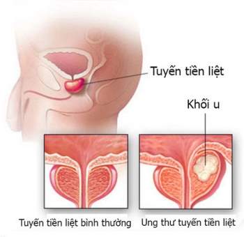 Dấu hiệu ung thư tiền liệt tuyến là gì? - 1