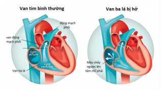 Hở van tim là bệnh phổ biến nhất trong các bệnh về tim mạch hiện nay.