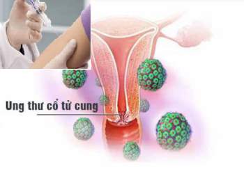 Tiêm vắc-xin HPV để phòng ngừa ung thư cổ tử cung.
