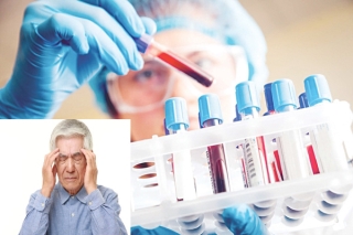 Xét nghiệm máu giúp chẩn đoán Alzheimer