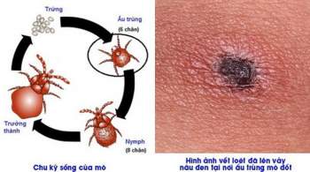 Sốt mò là bệnh truyền nhiễm cấp tính gây ra bởi vi khuẩn Orientia tsutsugamushi.