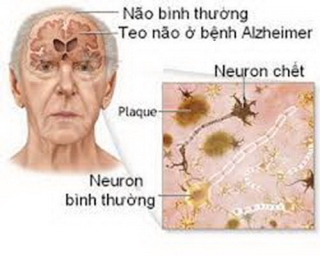 Alzheimer là bệnh mất trí nhớ dần dần, hay xuất hiện ở người lớn tuổi.