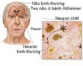 Não ở bệnh nhân Alzheimer