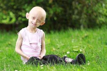 Hội chứng Progeria