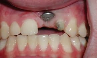 cấy ghép răng
