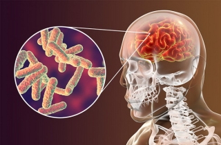 Lao màng não xuất hiện khi vi khuẩn lao đi theo đường máu tấn công não và màng não.