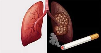 Thanh lọc phổi dành riêng cho người hút Thuốc lá