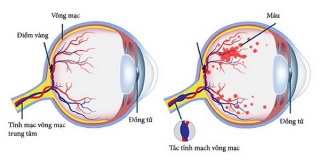 Tắc tĩnh mạch võng mạc .